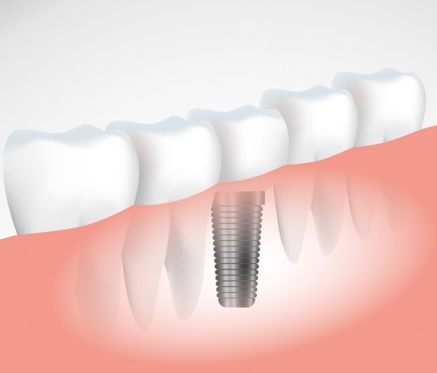 Dental Implants in Milton